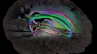 南加州大学通过大数据研究以探讨性别与患阿尔茨海默症风险之间的联系