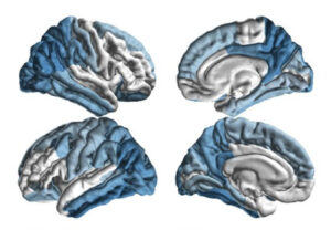 USC研究所启动全球帕金森病研究-南加州大学中文官网